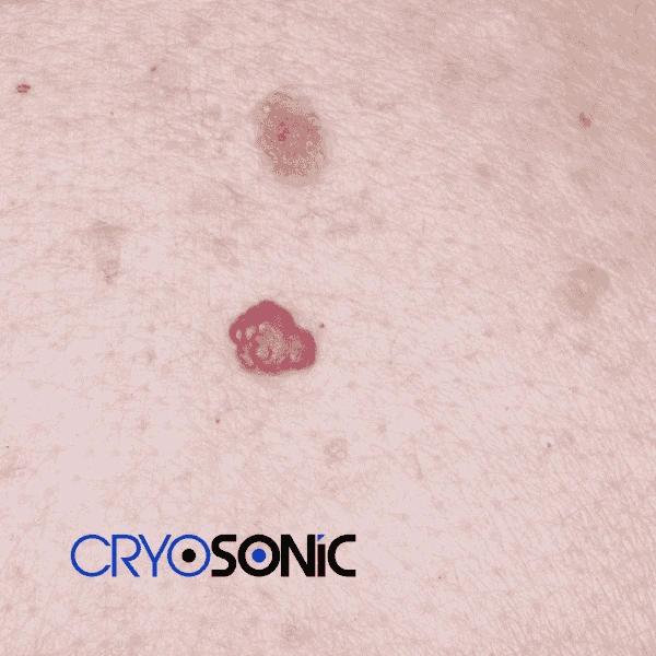 Looking for pain free cherry angioma removal treatment Eastleigh? Call our team today! Eastleigh
