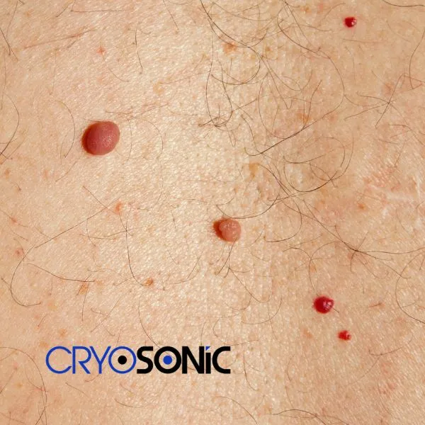 get cherry angioma removal treatment today! Eastleigh