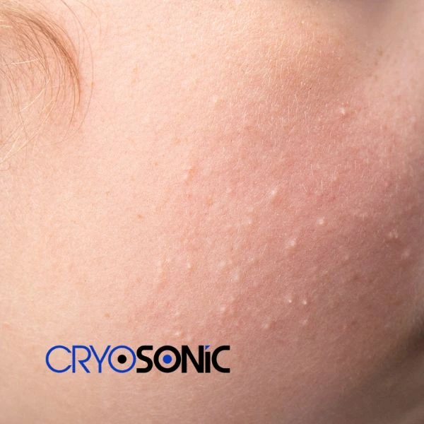 Are you looking for milia removal treatment? Contact our team today Eastleigh