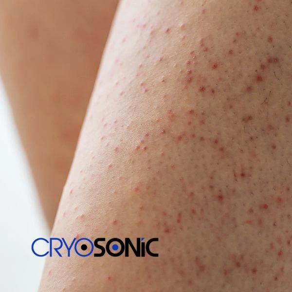 Looking for Seborrhoeic Keratosis removal Eastleigh treatment? Call our consultants today in Eastleigh
