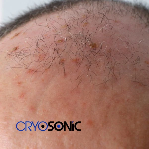 Access Seborrhoeic Keratosis removal from the comfort of your own home! Call us today in Eastleigh