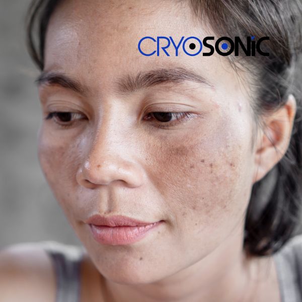 Ready to start age spots removal? Contact our team today in Eastleigh