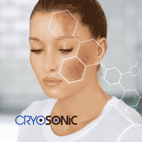Are you looking for age spot removal treatment? Contact Cryosonic today in Eastleigh