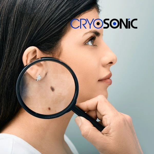 Do you want to learn more about benign moles removal treatment? Call our team today Eastleigh