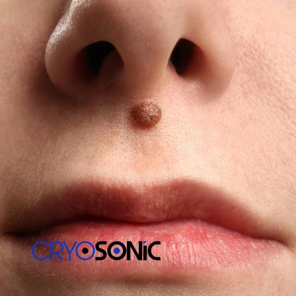 Start your benign moles removal treatment today Eastleigh