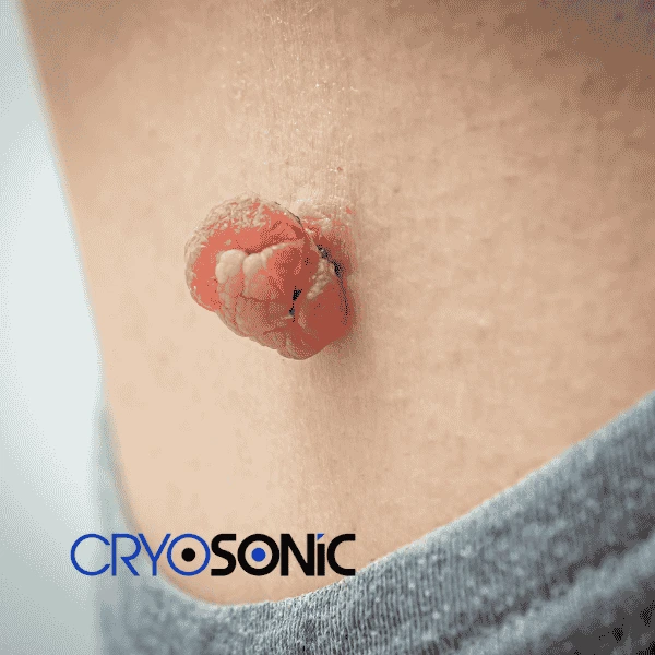 Book your skin tags removal Eastleigh from comfort of your own home! Eastleigh