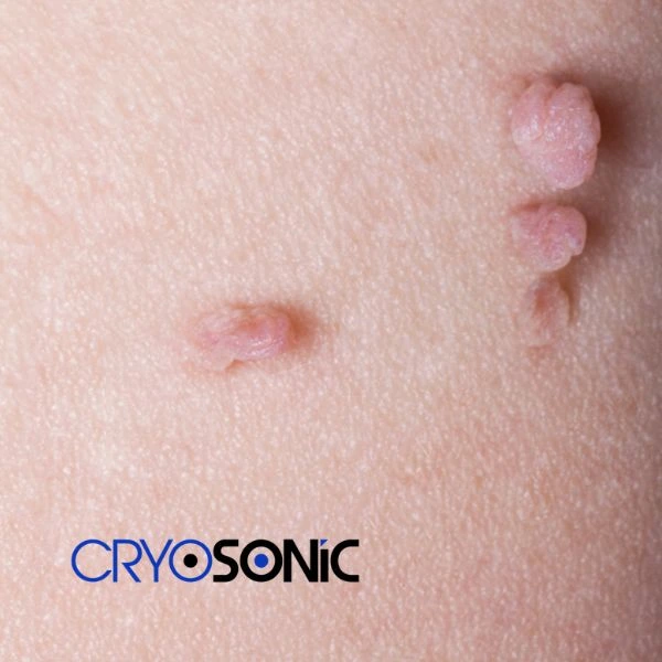 Are you looking for fast effect skin tag removal Eastleigh? Book in NOW! Eastleigh