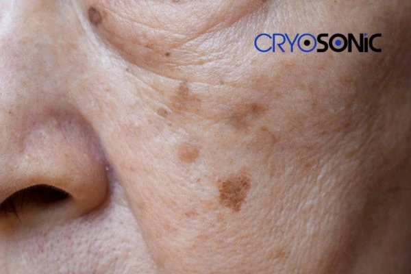 Protecting Your Skin from Sun Damage and Age Spots Eastleigh