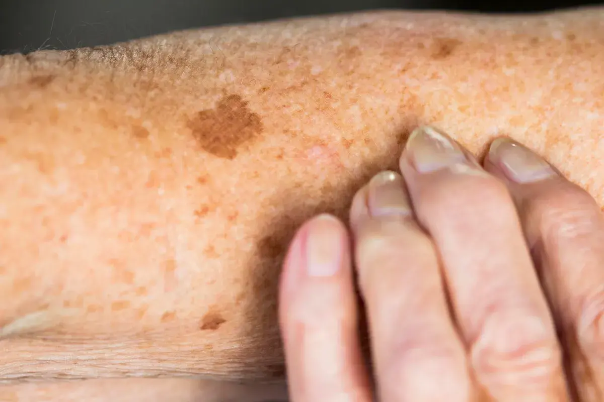 FAQs for Protecting Your Skin from Sun Damage Eastleigh