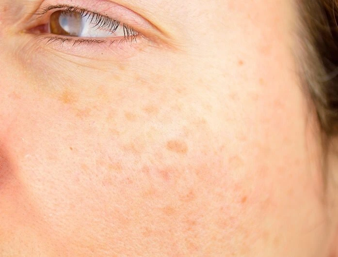 How Can Sun Protection Support Age Spot Treatments Eastleigh