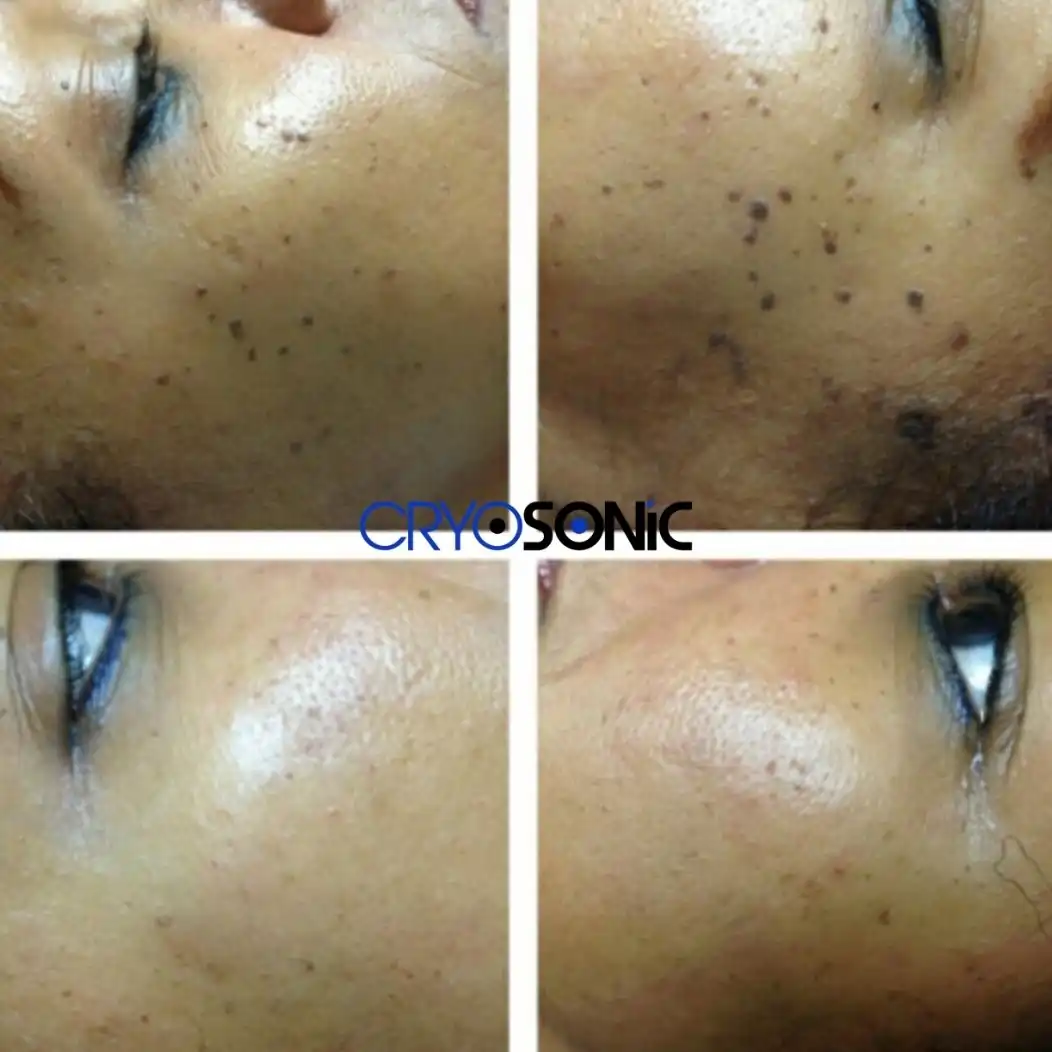 Cryotherapy for Dark Skin: Pigmentation Risks and Specific Protocols Eastleigh