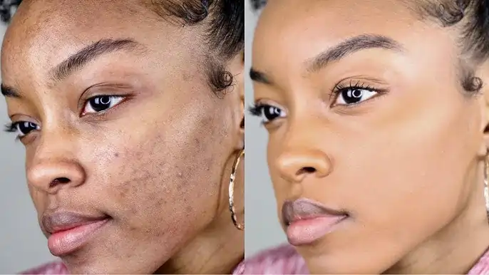 FAQs About Cryotherapy for Darker Skin Eastleigh