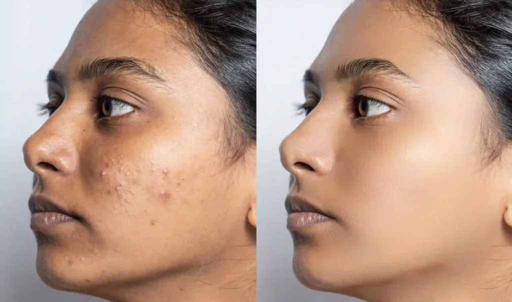 When Is Cryotherapy Not Recommended for Darker Skin Eastleigh