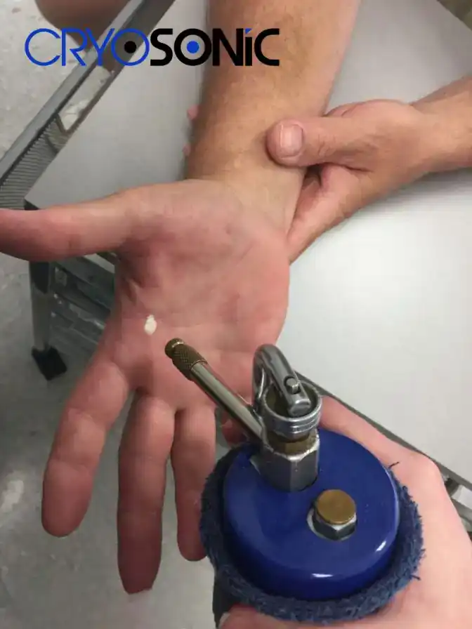 Temperature Differences: OTC vs Medical-Grade Cryotherapy Eastleigh